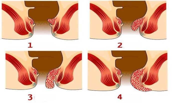 kako izgledaju hemoroidi u različitim fazama